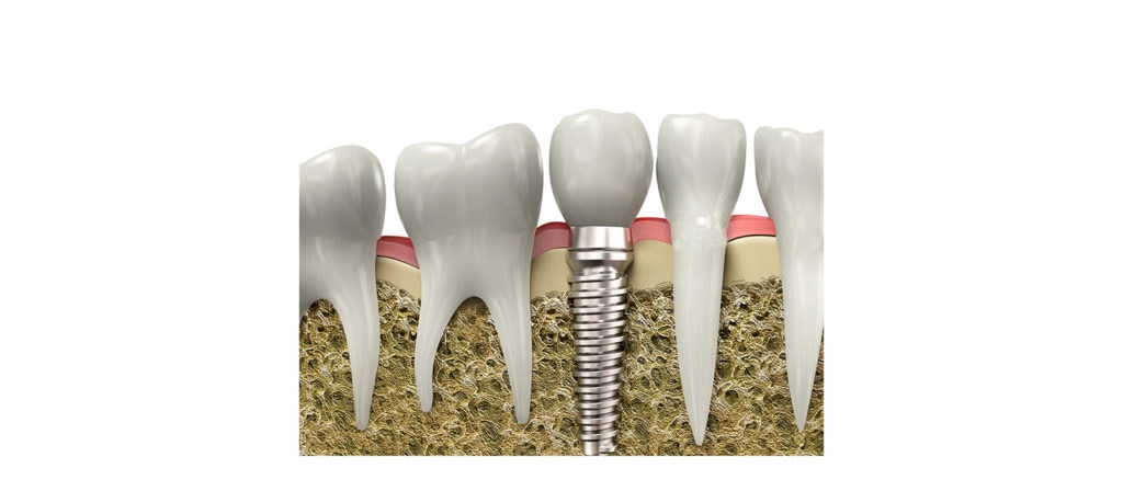 tooth implant dental procedure