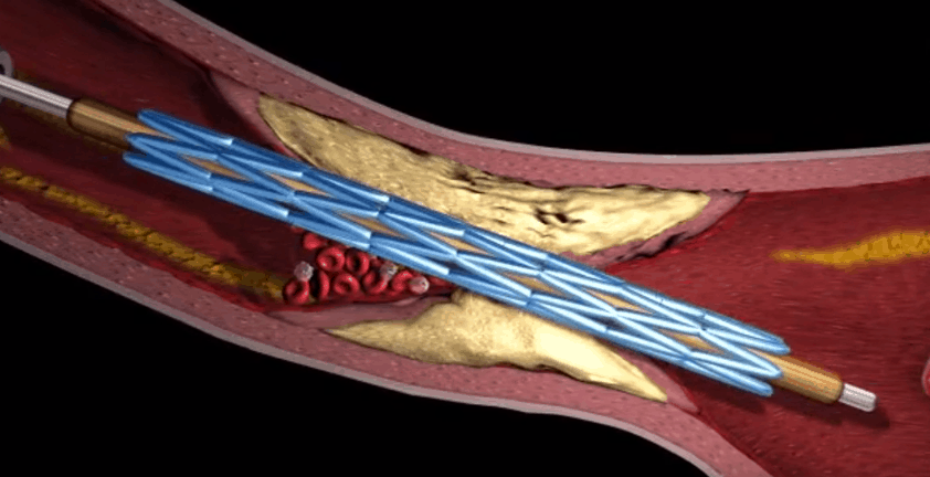 Angioplasty Stents Animation | Heart Surgery 3D Animation