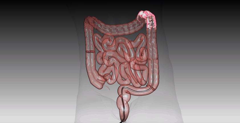 Colonoscopy Endoscope 3D Medical Animation