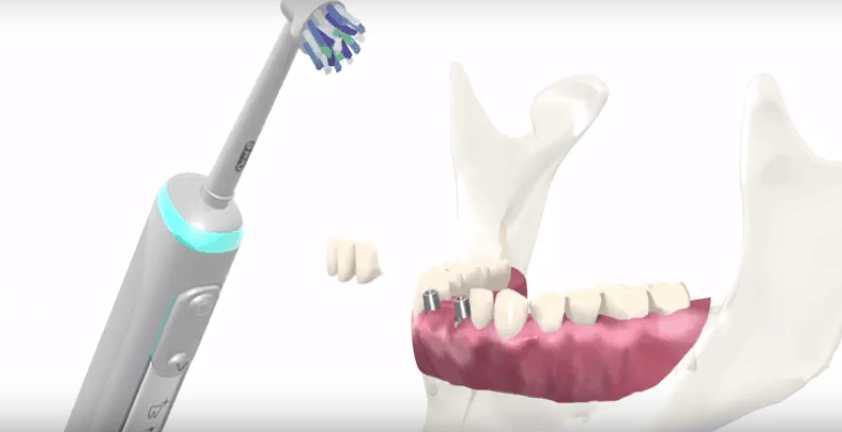 Dental Orthodontic Correction Procedure Tooth Replacement Medical 3D Animation