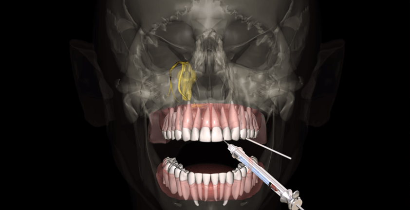 Anesthesia 3D Animation Visualization | Dental 3D Animation