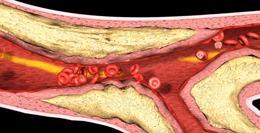 Myocardial Infarction Thrombosis 3D Animation