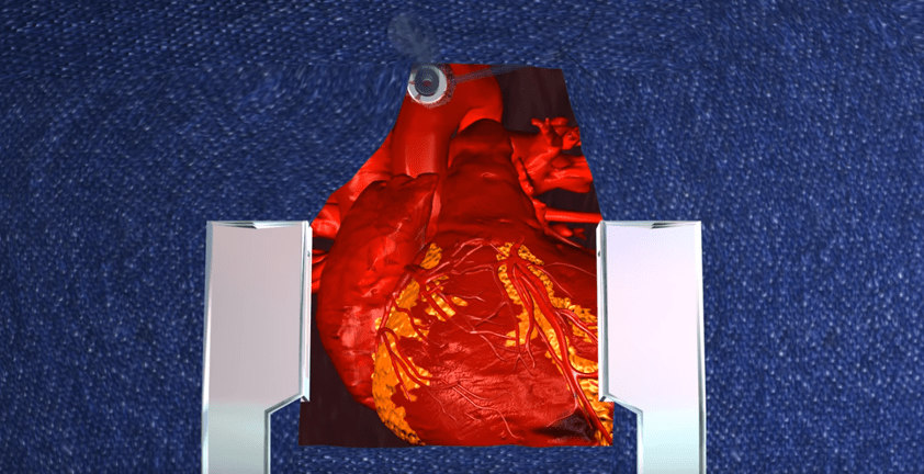 Heart Surgery 3D Animation Medical Visualization