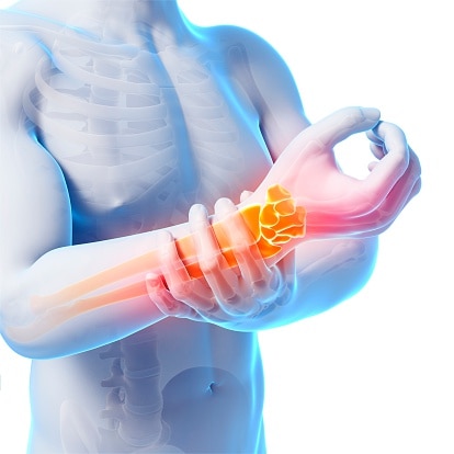 injury-3d-medical-3d-animation-company-studio-austin-visualshuman wrist pain