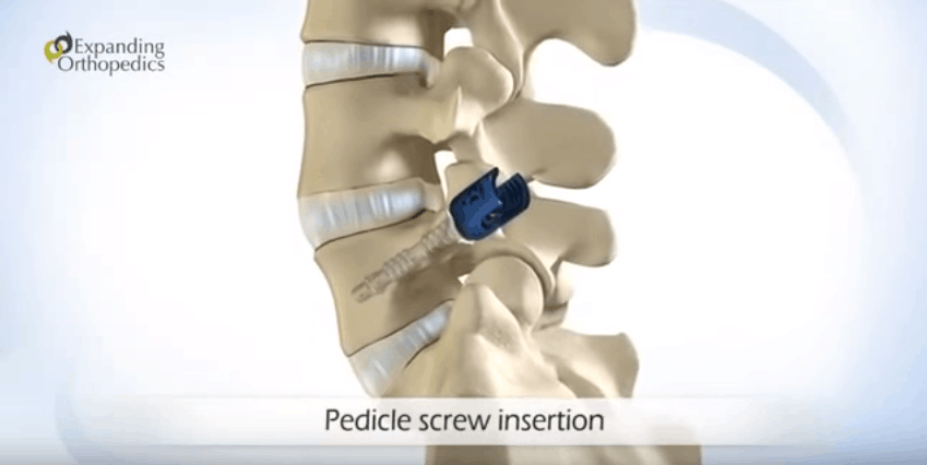 Orthopedic Spinal Screw System Medical 3D Animation Explainer Video