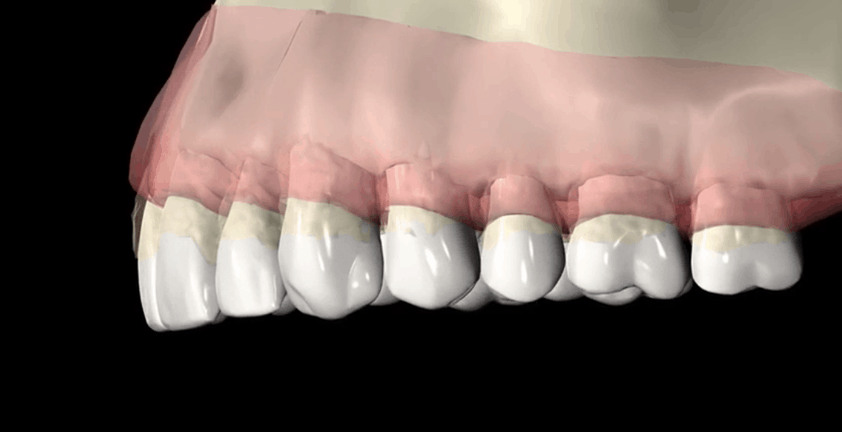 Periodontal Disease Medical Visualization 3D Animation